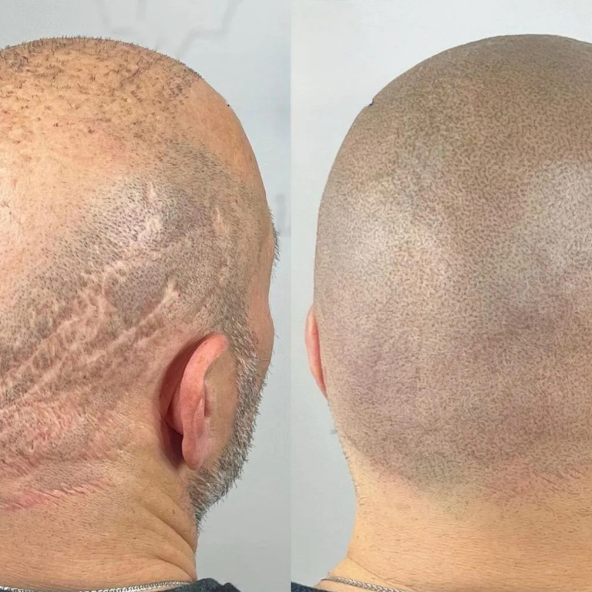 SMP scar camouflage on scalp in Omaha