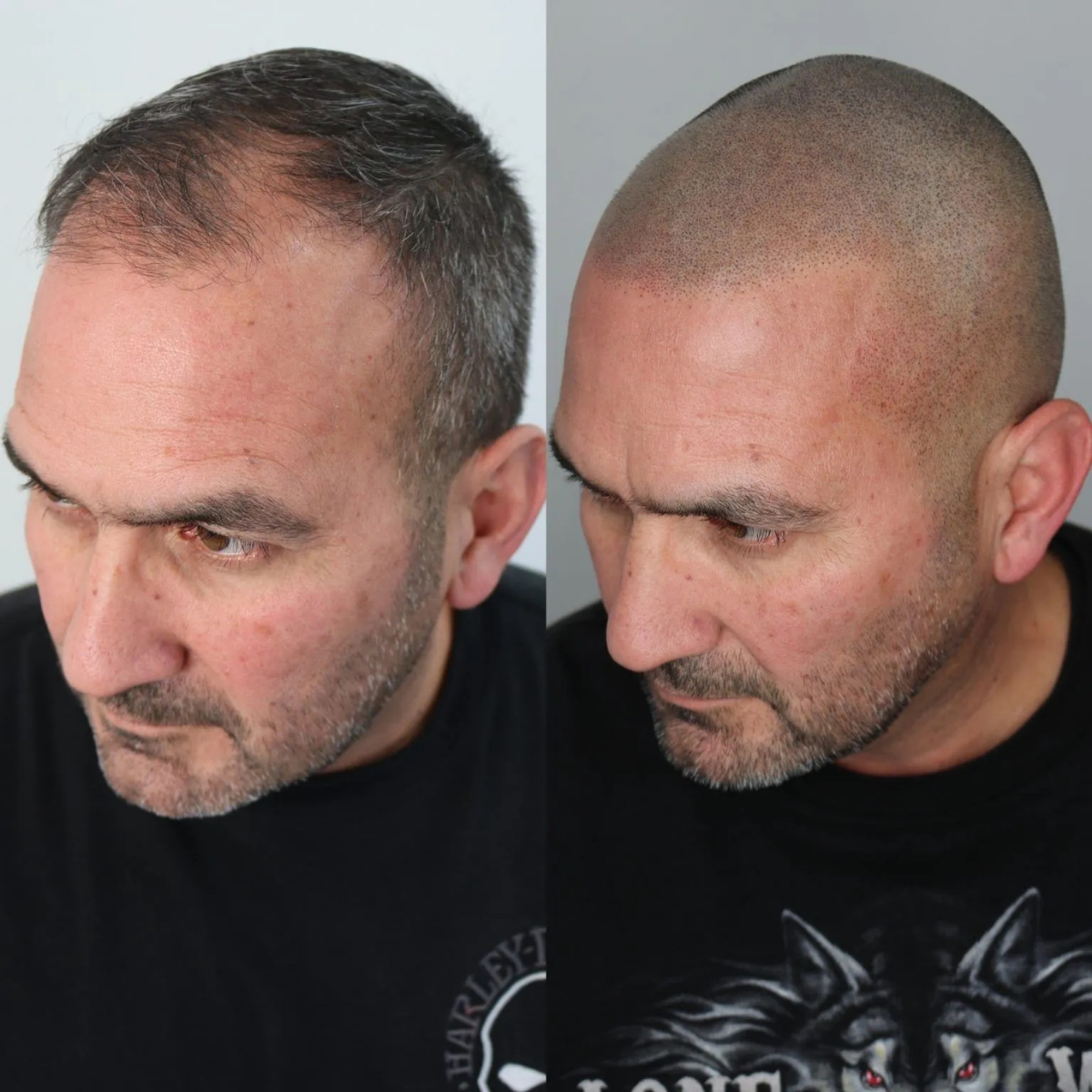 Scalp micropigmentation treatment in progress in Omaha Nebraska