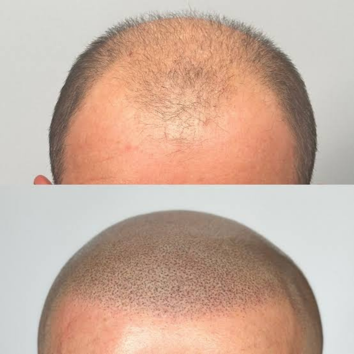 Scalp micropigmentation treatment iN Omaha Nebraska