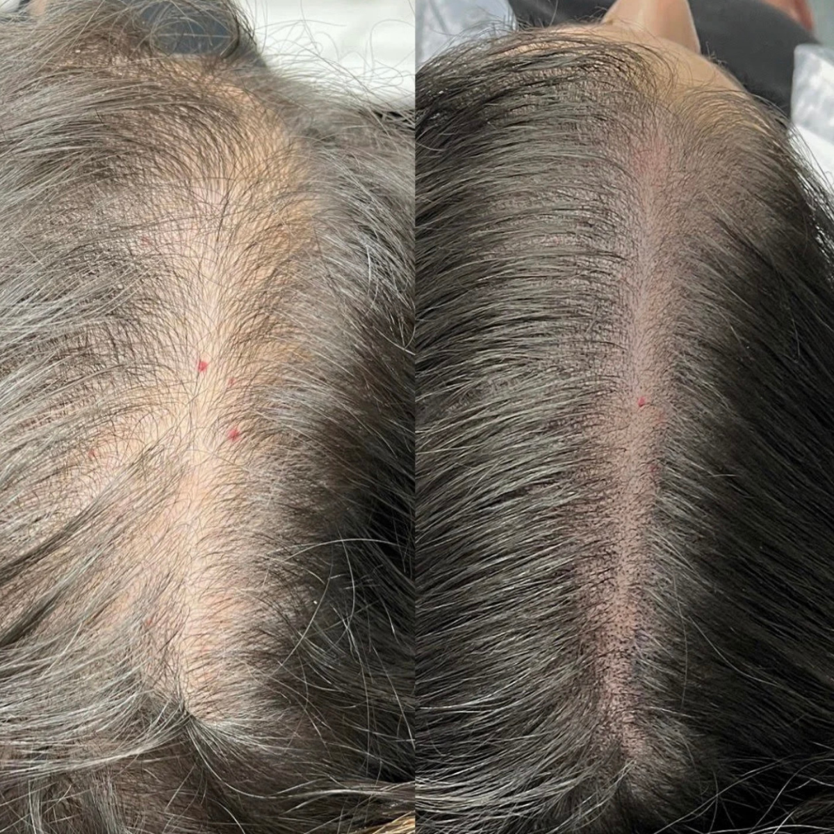 Female Scalp micropigmentation treatment in progress in Omaha Nebraska