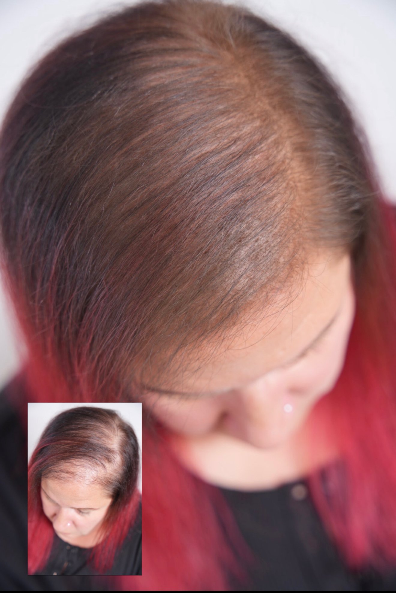 Scalp micropigmentation density treatment before and after for thinning hair