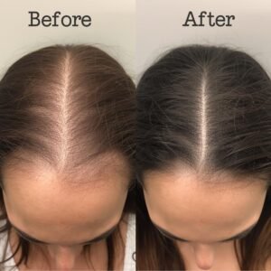 before and after scalp micropigmentation on a woman